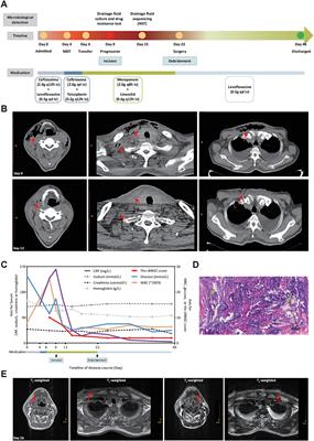 Rapid and precise identification of cervicothoracic necrotizing fasciitis caused by Prevotella and Streptococcus constellatus by using Nanopore sequencing technology: a case report